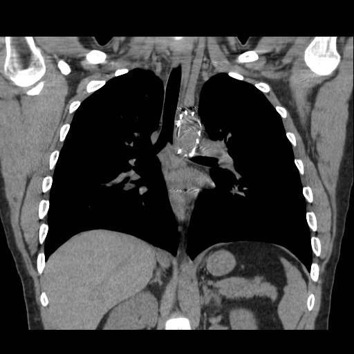 File:Aortic arch stent (Radiopaedia 30030-30595 Coronal non-contrast 15).jpg
