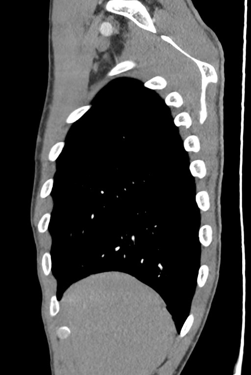 Aortic coarctation with aneurysm (Radiopaedia 74818-85828 B 30).jpg