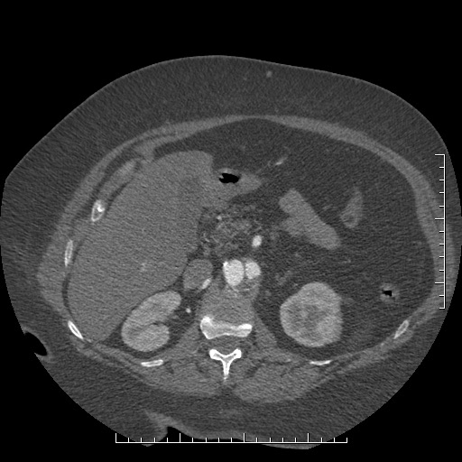 Aortic dissection- Stanford A (Radiopaedia 35729-37268 B 55).jpg