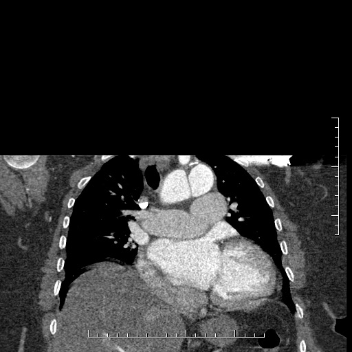 File:Aortic dissection- Stanford A (Radiopaedia 35729-37268 E 32).jpg