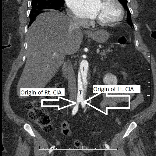 File:Aortic dissection- Stanford A (Radiopaedia 35729-39076 Multiple Annotated 9).jpg