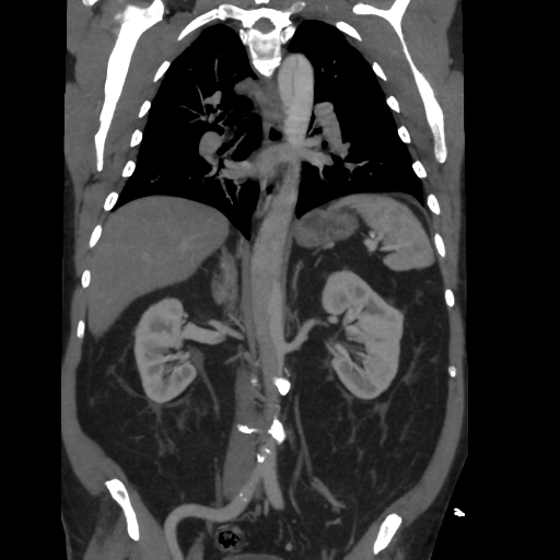 File:Aortic dissection- Stanford A (Radiopaedia 37759-39664 Coronal C+ delayed 30).png