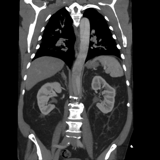 File:Aortic dissection- Stanford A (Radiopaedia 37759-39664 Coronal C+ delayed 32).png