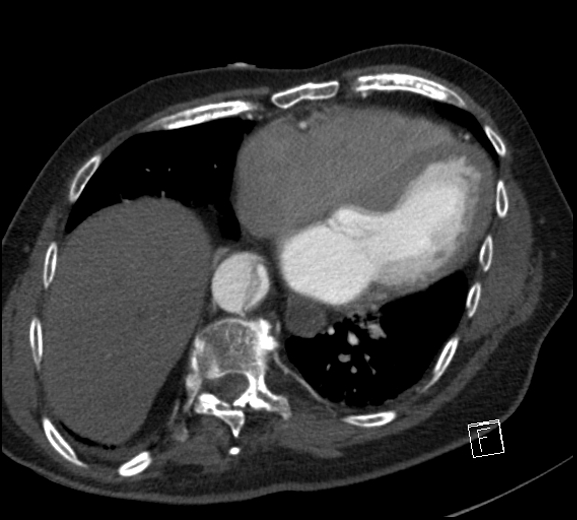 File:Aortic dissection (CTPA) (Radiopaedia 75506-86750 A 65).jpg
