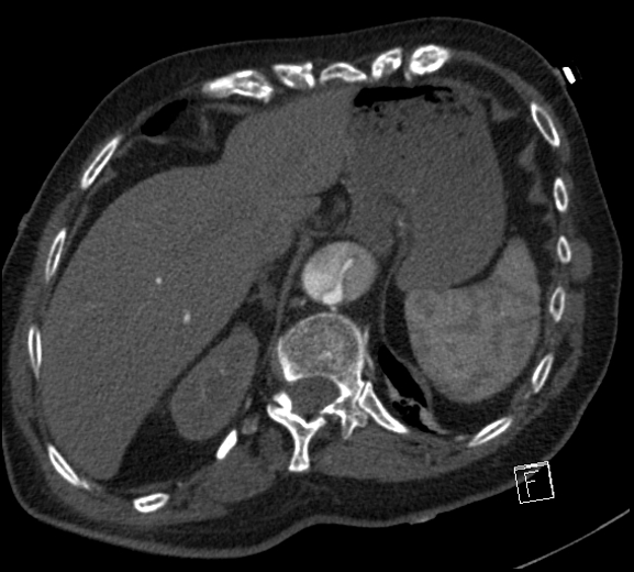 File:Aortic dissection (CTPA) (Radiopaedia 75506-86750 A 82).jpg
