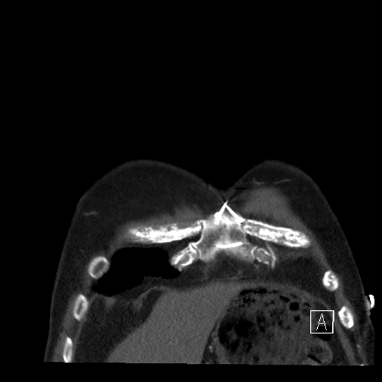 Aortic dissection (CTPA) (Radiopaedia 75506-86750 B 4).jpg