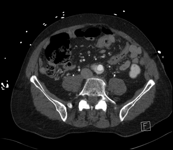 Aortic dissection (CTPA) (Radiopaedia 75506-86750 E 98).jpg
