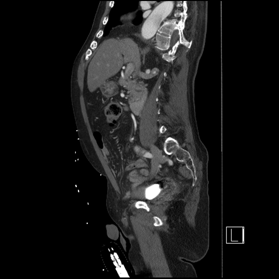 Aortic dissection (CTPA) (Radiopaedia 75506-86750 G 44).jpg