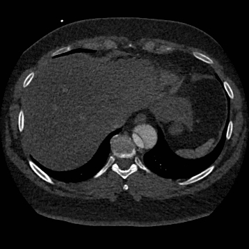 Aortic dissection (Radiopaedia 57969-64959 A 251).jpg