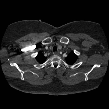 Aortic dissection (Radiopaedia 57969-64959 A 44).jpg