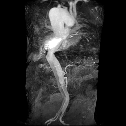 File:Aortic dissection - Stanford A - DeBakey I (Radiopaedia 23469-23551 MRA 12).jpg