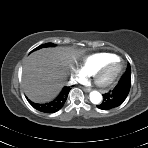 File:Aortic dissection - Stanford type A (Radiopaedia 39073-41259 A 59).png