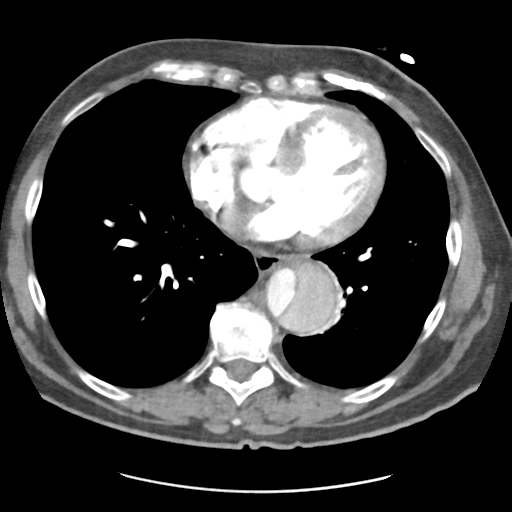 File:Aortic dissection - Stanford type B (Radiopaedia 50171-55512 A 33).png