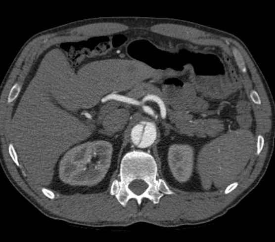 Aortic dissection - Stanford type B (Radiopaedia 73648-84437 A 126).jpg