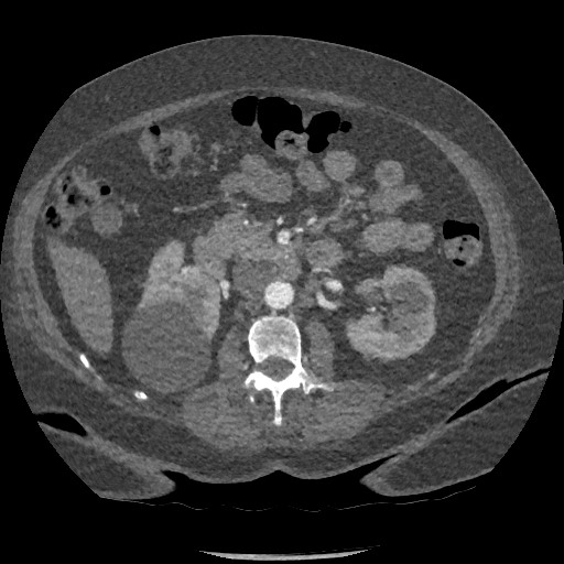 Aortic dissection - Stanford type B (Radiopaedia 88281-104910 A 117).jpg