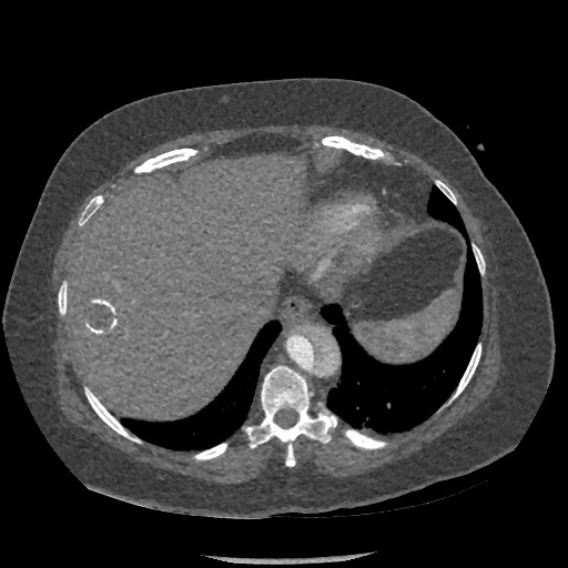 Aortic dissection - Stanford type B (Radiopaedia 88281-104910 A 78).jpg