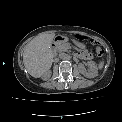 File:Aortic dissection extended to lusory artery (Radiopaedia 43686-47136 Axial non-contrast 33).jpg