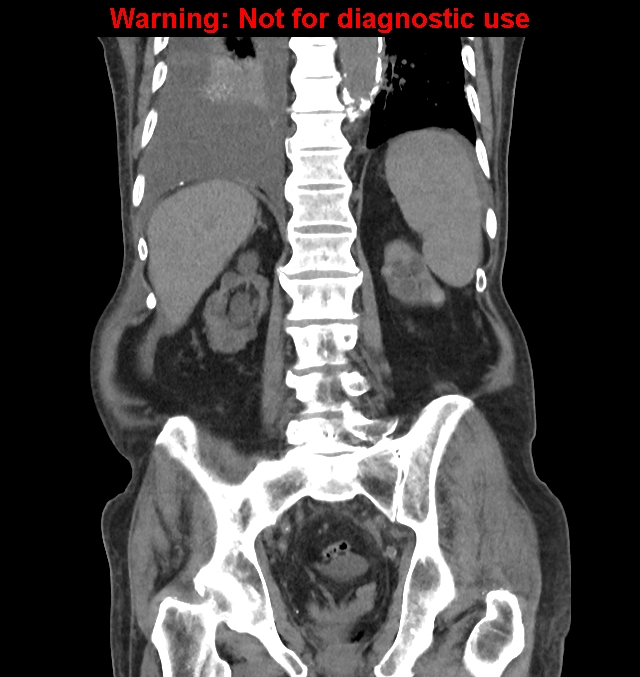 Aortic graft infection (Radiopaedia 44979-48907 non-contrast 36).jpg