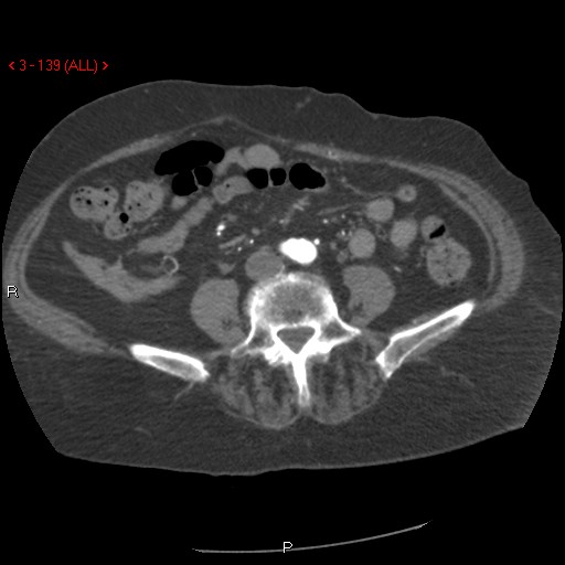 Aortic intramural hematoma (Radiopaedia 27746-28001 A 139).jpg