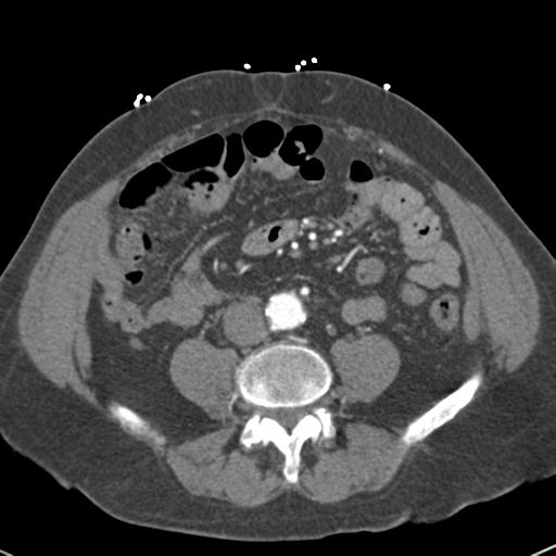 Aortic intramural hematoma (Radiopaedia 31139-31838 B 122).jpg
