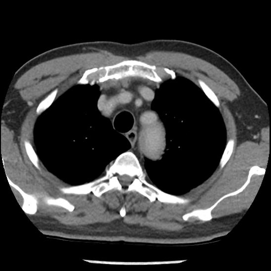Aortic intramural hematoma (type B) (Radiopaedia 79323-92387 Axial C+ delayed 9).jpg