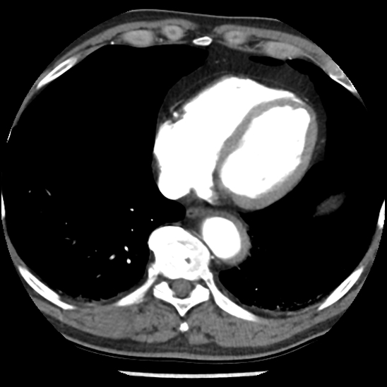 File:Aortic intramural hematoma (type B) (Radiopaedia 79323-92387 B 40).jpg