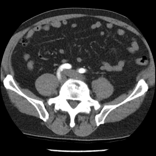 File:Aortic intramural hematoma (type B) (Radiopaedia 79323-92387 B 87).jpg