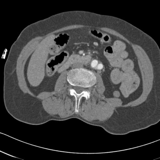 Aortic intramural hematoma from penetrating atherosclerotic ulcer (Radiopaedia 31137-31836 A 112).jpg