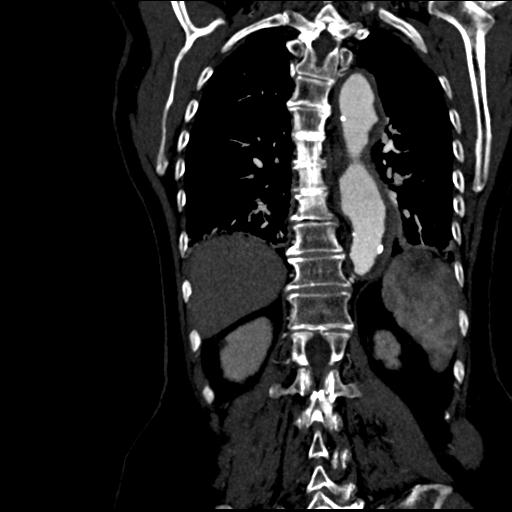 File:Aortic intramural hematoma from penetrating atherosclerotic ulcer (Radiopaedia 31137-31836 C 49).jpg