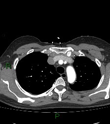 Aortic valve endocarditis (Radiopaedia 87209-103485 C 22).jpg