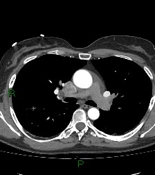 Aortic valve endocarditis (Radiopaedia 87209-103485 C 39).jpg