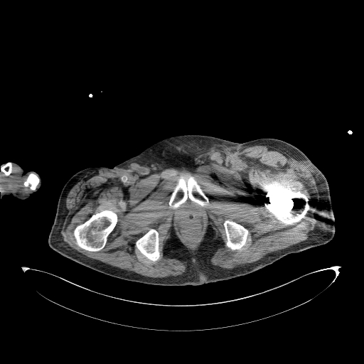 Aortoduodenal fistula (Radiopaedia 75286-86415 Axial non-contrast 80).jpg