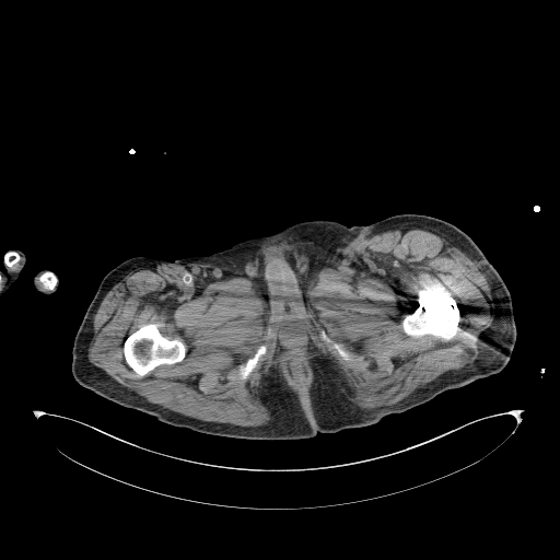 Aortoduodenal fistula (Radiopaedia 75286-86415 Axial non-contrast 86).jpg