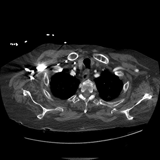 File:Aortoesophageal fistula with endovascular repair (Radiopaedia 73781-84592 Axial C+ CTPA 4).jpg