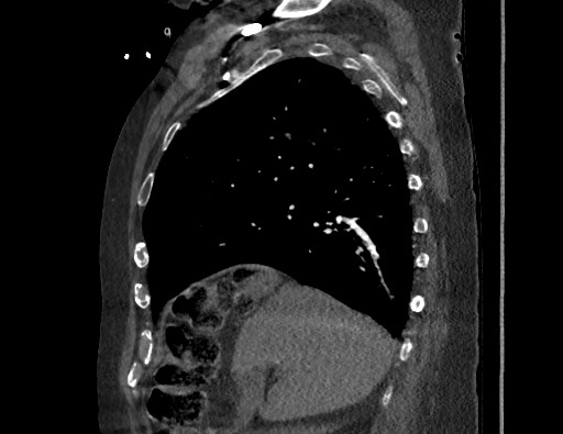 Aortoesophageal fistula with endovascular repair (Radiopaedia 73781-84592 Sagittal C+ CTPA 57).jpg
