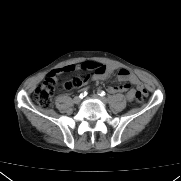 Aortoiliac occlusive disease (Radiopaedia 32134-33076 Axial non-contrast 34).jpg