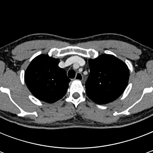 Apical lung mass mimic - neurogenic tumor (Radiopaedia 59918-67521 A 19).jpg
