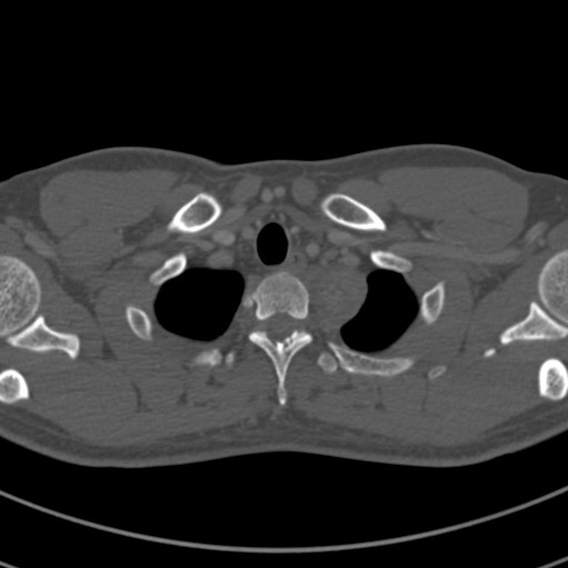 Apical lung mass mimic - neurogenic tumor (Radiopaedia 59918-67521 Axial bone window 8).jpg