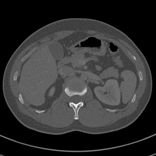 File:Apical lung mass mimic - neurogenic tumor (Radiopaedia 59918-67521 Axial bone window 91).jpg