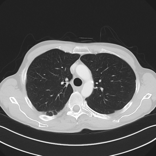 Apical pleural calcification (Radiopaedia 46141-50499 Axial lung window 22).png