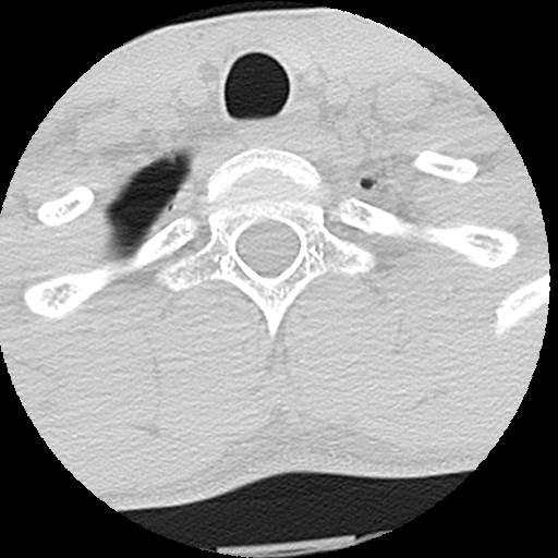 File:Apical pneumothorax on cervical spine CT (Radiopaedia 45343-49368 Axial lung window 4).jpg