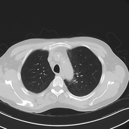 File:Apical pulmonary metastasis (Radiopaedia 46338-50754 Axial non-contrast 18).png