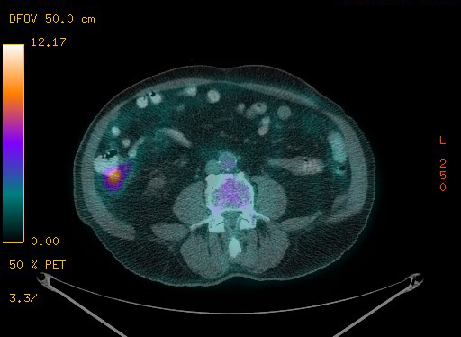 Appendiceal adenocarcinoma complicated by retroperitoneal abscess (Radiopaedia 58007-65041 Axial PET-CT 142).jpg
