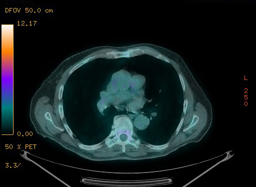 Appendiceal adenocarcinoma complicated by retroperitoneal abscess (Radiopaedia 58007-65041 Axial PET-CT 69).jpg