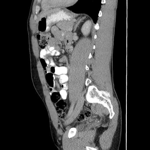 Appendicitis complicated by post-operative collection (Radiopaedia 35595-37114 C 46).jpg