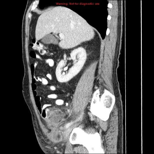 File:Appendicitis mass in inguinal hernia (Radiopaedia 26858-27029 C 17).jpg