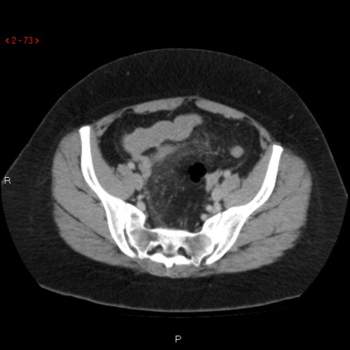 Appendicitis with microperforation- promontoric type (Radiopaedia 27268-27442 C 61).jpg