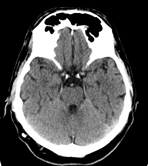 File:Aqueduct stenosis with corpus callosum hypoattenuation post shunting (Radiopaedia 37212-38971 Axial non-contrast 9).png