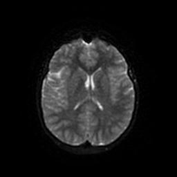 Arachnoid cyst - middle cranial fossa (Radiopaedia 67671-77088 Axial DWI 43).jpg