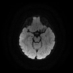 Arachnoid cyst - middle cranial fossa (Radiopaedia 86780-102938 Axial DWI 18).jpg